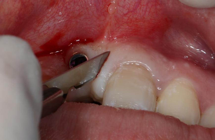 牙槽骨手术失败图片图片
