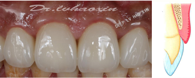牙龈生物型 i 类:角化龈正常(厚3