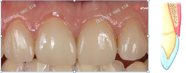 牙龈生物型 i 类:角化龈正常(厚3