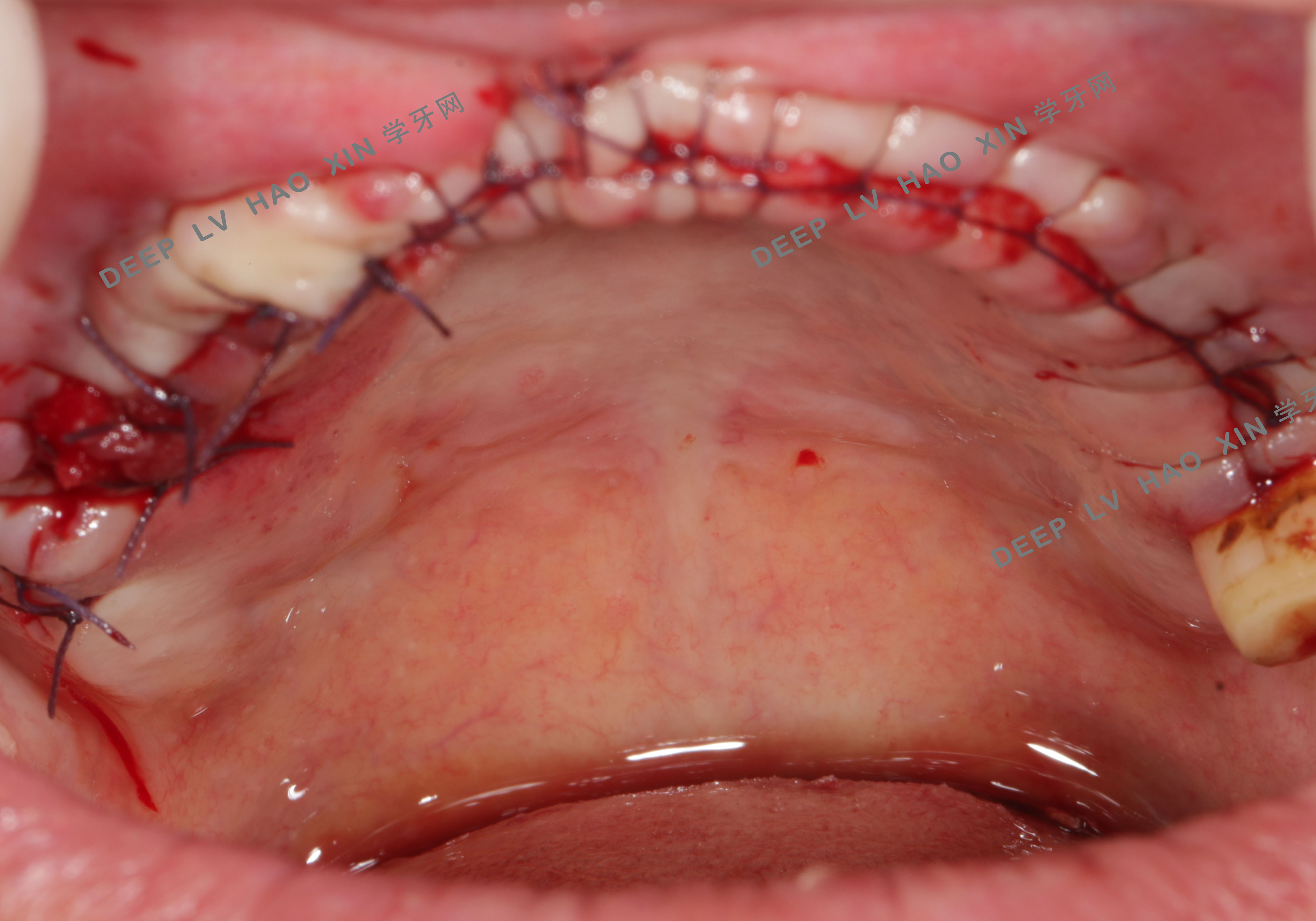 口腔锚式缝合图片